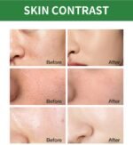 Acne Removal Mousse Facial Cleanser - Image 6